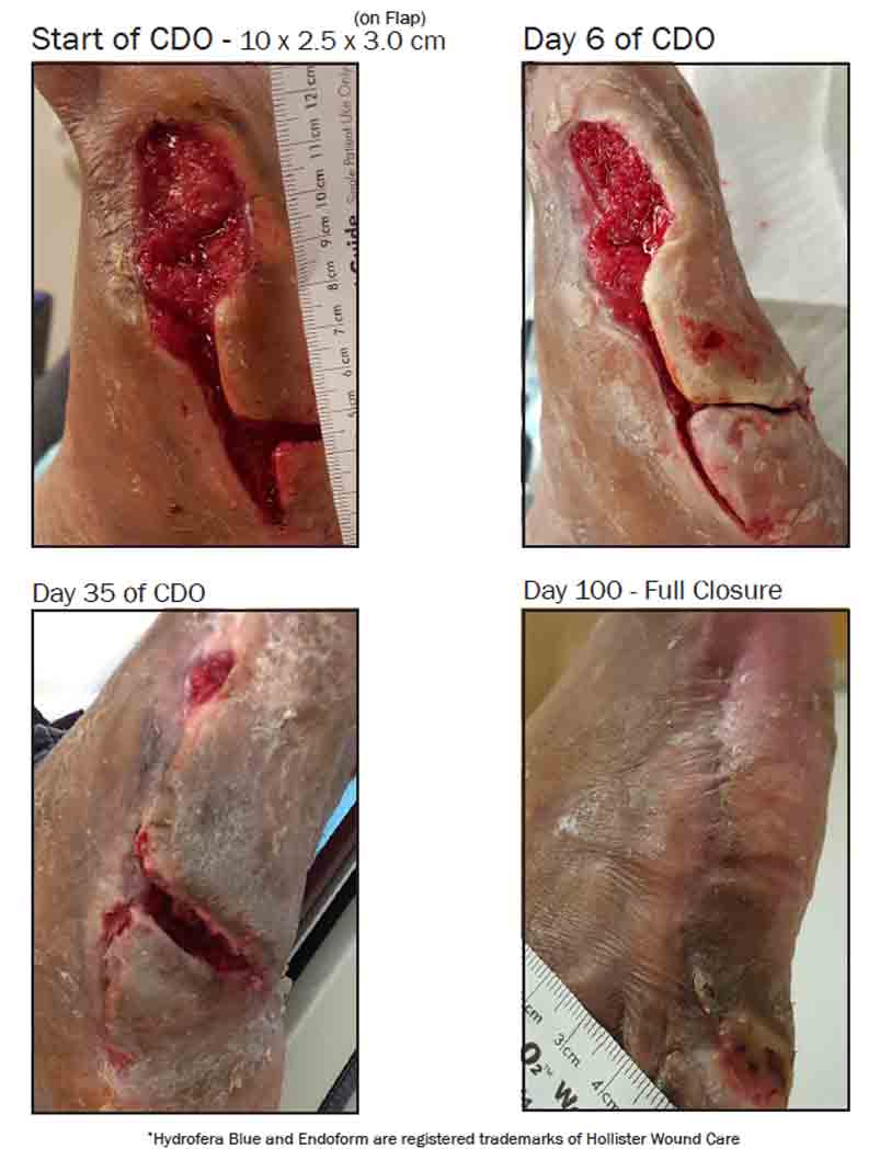 non-healing-diabetic-foot-ulcer-cdo-phx-2 - Innovative Wound Healing