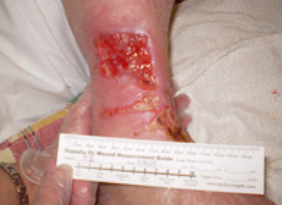 Treatment of Venous Leg Ulcer using CDO Therapy
