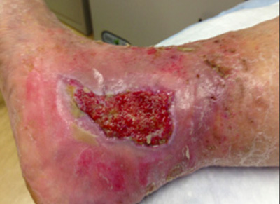 Treatment of a Venous Leg Ulcer using TransCu O2